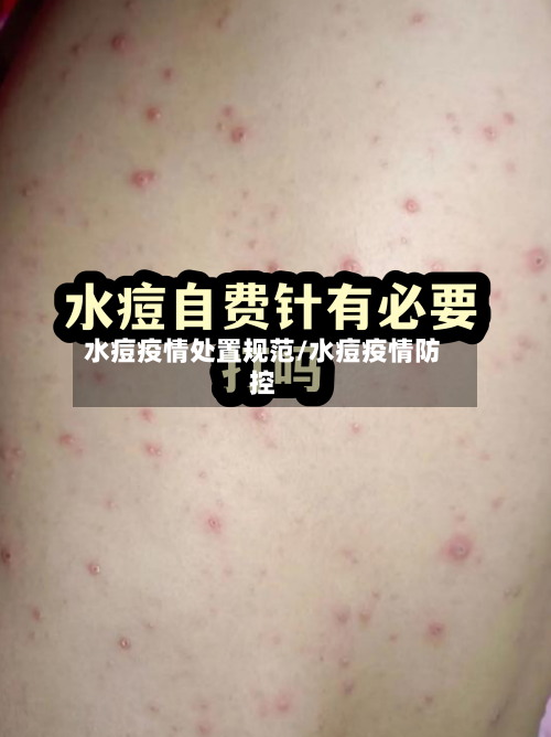 水痘疫情处置规范/水痘疫情防控-第2张图片